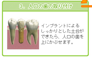 ３．人口の歯の取り付け　インプラントによるしっかりとした土台ができたら、人口の歯を上にかぶせます。
